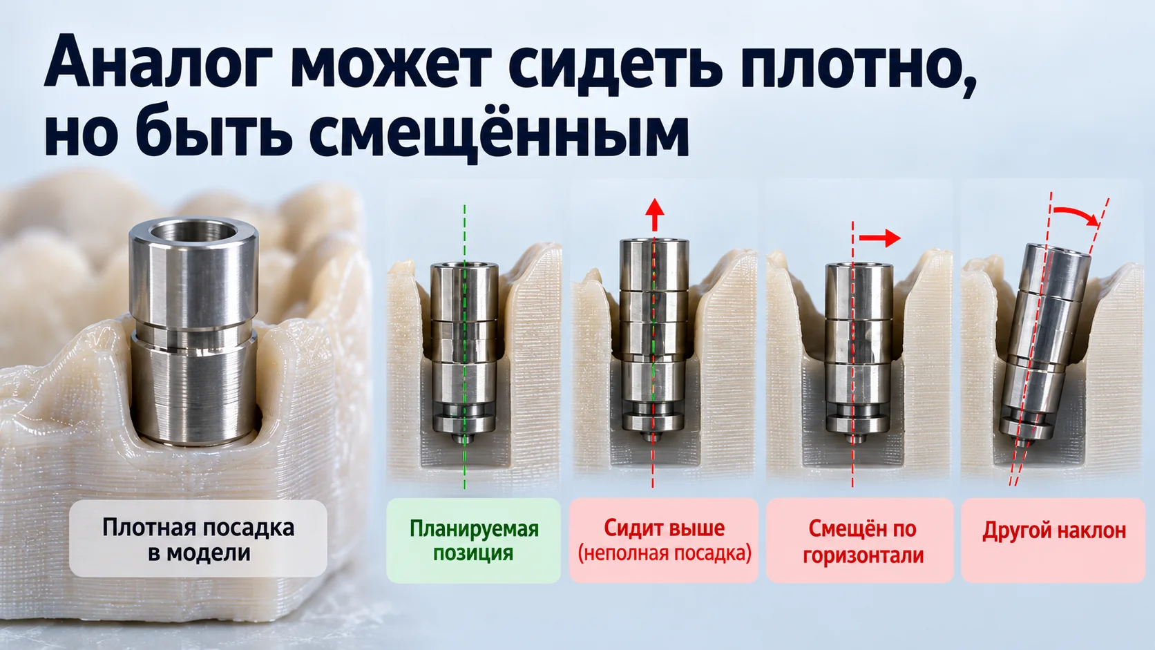 Плотная посадка и смещение имплантатного аналога в 3D-печатной модели